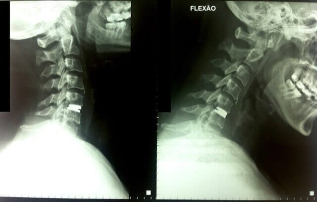 Artroplastia Cervical