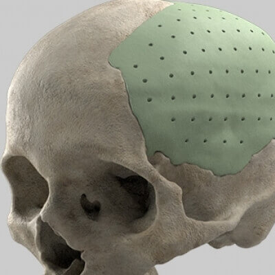Cranioplastia