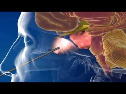 Tumor de Hipofise
